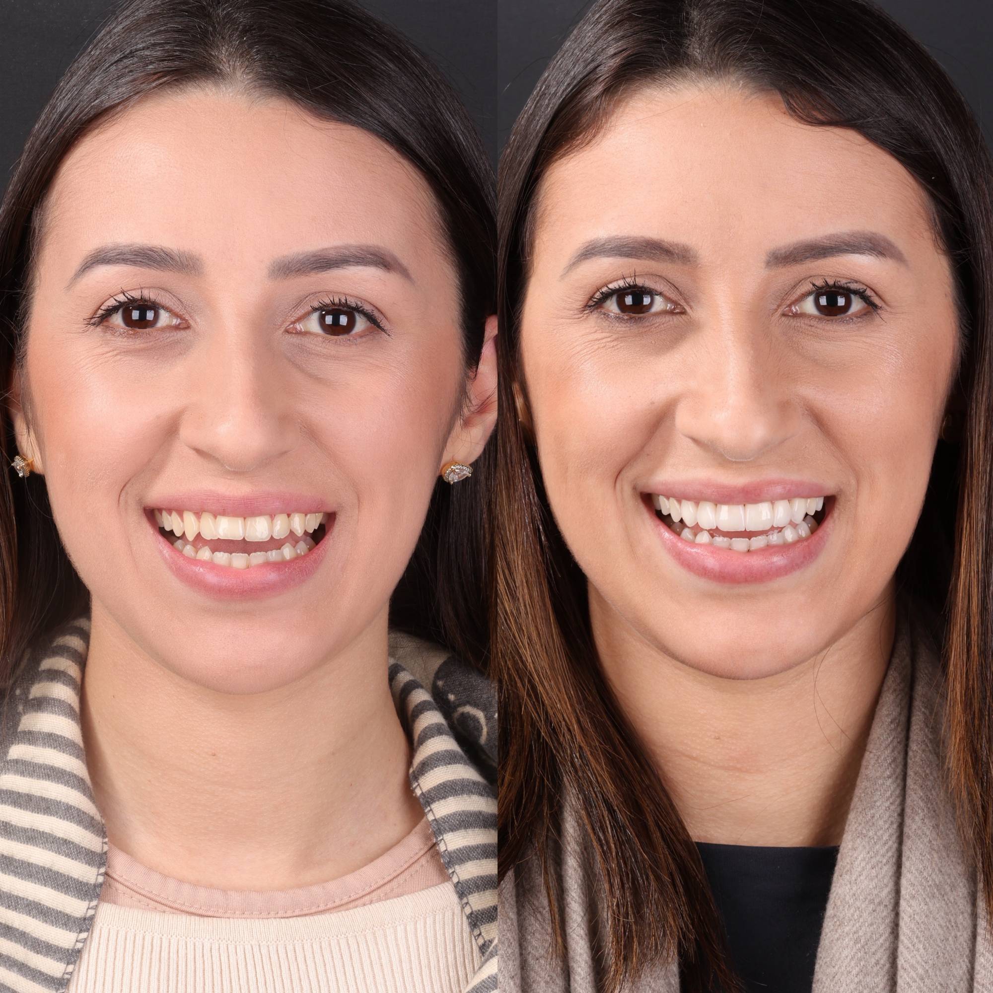 Antes e depois — paciente da Humanize Odontologia