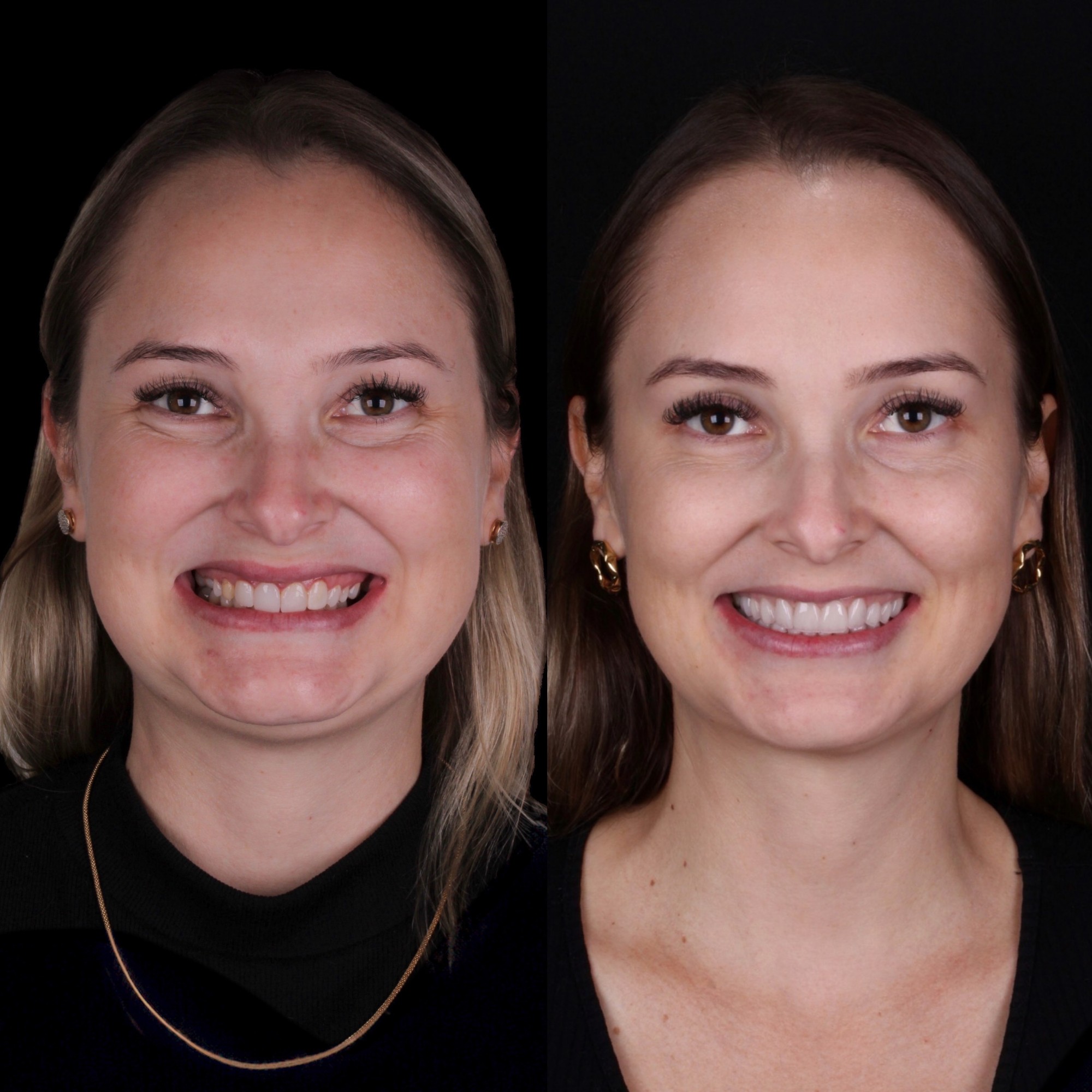 Antes e depois — paciente da Humanize Odontologia