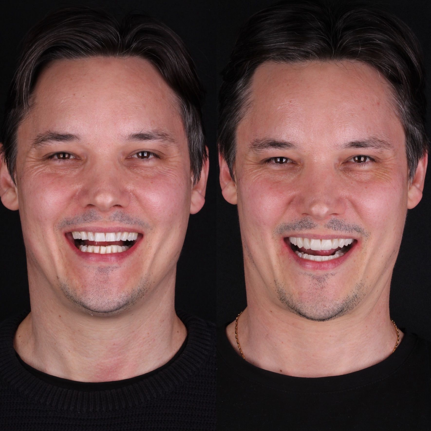 Antes e depois — paciente da Humanize Odontologia